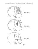 SYSTEMS, METHODS AND DEVICES FOR A SKULL/BRAIN INTERFACE diagram and image