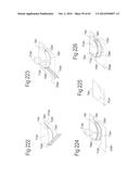 DEVICE FOR REMOVING ACROCHORDONS diagram and image