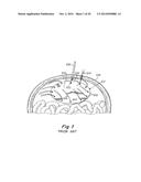 INSTRUMENTS FOR DELIVERING TRANSFASCIAL SUTURES, TRANSFASCIAL SUTURE     ASSEMBLIES AND METHODS OF TRANSFASCIAL SUTURING diagram and image