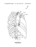 NONINVASIVE DEVICE FOR ADJUSTING FASTENER diagram and image