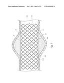 GRADUALLY SELF-EXPANDING STENT diagram and image