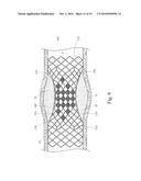 GRADUALLY SELF-EXPANDING STENT diagram and image