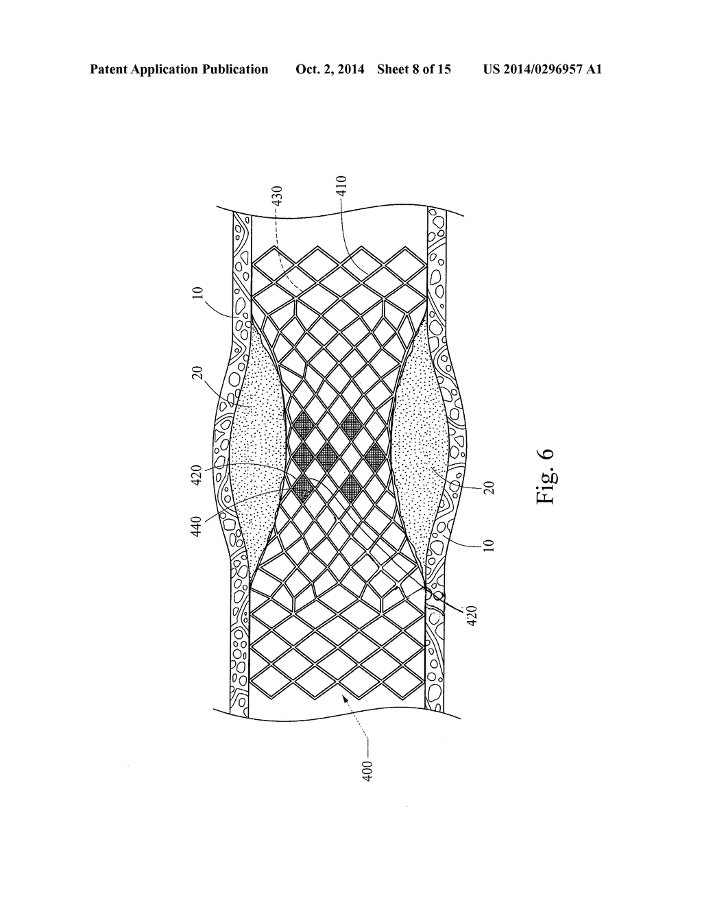 GRADUALLY SELF-EXPANDING STENT - diagram, schematic, and image 09