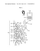 BREAST IMPLANT WITH REGIONALIZED ANALYTE SENSORS AND INTERNAL POWER SOURCE diagram and image