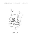 KNEE ARTHROPLASTY TIBIA COMPONENT AND KNEE ARTHROPLASTY diagram and image