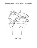 KNEE ARTHROPLASTY TIBIA COMPONENT AND KNEE ARTHROPLASTY diagram and image