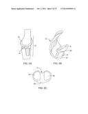 SYSTEMS AND METHODS FOR PROVIDING AN ASYMMETRICAL FEMORAL COMPONENT diagram and image