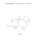 SYSTEMS AND METHODS FOR PROVIDING AN ASYMMETRICAL FEMORAL COMPONENT diagram and image