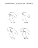 SYSTEMS AND METHODS FOR PROVIDING AN ASYMMETRICAL FEMORAL COMPONENT diagram and image