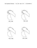 SYSTEMS AND METHODS FOR PROVIDING AN ASYMMETRICAL FEMORAL COMPONENT diagram and image