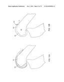 SYSTEMS AND METHODS FOR PROVIDING AN ASYMMETRICAL FEMORAL COMPONENT diagram and image