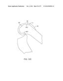 SYSTEMS AND METHODS FOR PROVIDING AN ASYMMETRICAL FEMORAL COMPONENT diagram and image