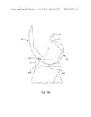 SYSTEMS AND METHODS FOR PROVIDING AN ASYMMETRICAL FEMORAL COMPONENT diagram and image