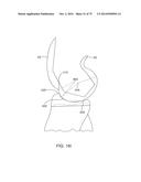 SYSTEMS AND METHODS FOR PROVIDING AN ASYMMETRICAL FEMORAL COMPONENT diagram and image