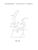 SYSTEMS AND METHODS FOR PROVIDING AN ASYMMETRICAL FEMORAL COMPONENT diagram and image