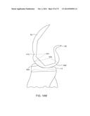 SYSTEMS AND METHODS FOR PROVIDING AN ASYMMETRICAL FEMORAL COMPONENT diagram and image