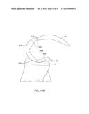 SYSTEMS AND METHODS FOR PROVIDING AN ASYMMETRICAL FEMORAL COMPONENT diagram and image