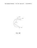 SYSTEMS AND METHODS FOR PROVIDING AN ASYMMETRICAL FEMORAL COMPONENT diagram and image