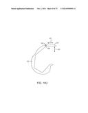 SYSTEMS AND METHODS FOR PROVIDING AN ASYMMETRICAL FEMORAL COMPONENT diagram and image