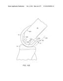 SYSTEMS AND METHODS FOR PROVIDING AN ASYMMETRICAL FEMORAL COMPONENT diagram and image