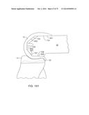 SYSTEMS AND METHODS FOR PROVIDING AN ASYMMETRICAL FEMORAL COMPONENT diagram and image