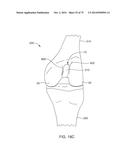 SYSTEMS AND METHODS FOR PROVIDING AN ASYMMETRICAL FEMORAL COMPONENT diagram and image