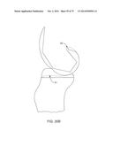 SYSTEMS AND METHODS FOR PROVIDING AN ASYMMETRICAL FEMORAL COMPONENT diagram and image