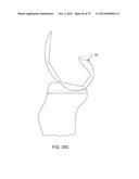 SYSTEMS AND METHODS FOR PROVIDING AN ASYMMETRICAL FEMORAL COMPONENT diagram and image