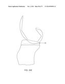 SYSTEMS AND METHODS FOR PROVIDING AN ASYMMETRICAL FEMORAL COMPONENT diagram and image