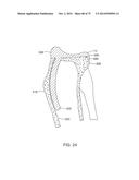 SYSTEMS AND METHODS FOR PROVIDING AN ASYMMETRICAL FEMORAL COMPONENT diagram and image