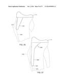 SYSTEMS AND METHODS FOR PROVIDING AN ASYMMETRICAL FEMORAL COMPONENT diagram and image