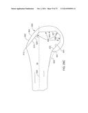 SYSTEMS AND METHODS FOR PROVIDING AN ASYMMETRICAL FEMORAL COMPONENT diagram and image