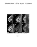 QUANTIFYING BREAST TISSUE CHANGES WITH SPECTRALLY SELECTIVE MRI AND MRS diagram and image