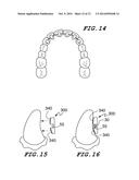 Orthodontic Wire Alignment System and Method diagram and image