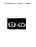 USE OF INHIBITORS OF BRUTON S TYROSINE KINASE (BTK) diagram and image