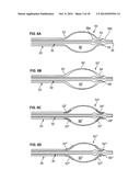 APPARATUS AND METHODS FOR TREATING OBSTRUCTIONS WITHIN BODY LUMENS diagram and image