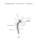 METHOD AND APPARATUS FOR DETERMINING THE ORIENTATION AND/OR POSITION OF AN     OBJECT DURING A MEDICAL PROCEDURE diagram and image