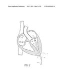 SUTURING DEVICES AND METHODS FOR SUTURING AN ANATOMIC VALVE diagram and image