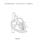 SUTURING DEVICES AND METHODS FOR SUTURING AN ANATOMIC VALVE diagram and image