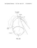 Water Enucleation of the Prostate diagram and image