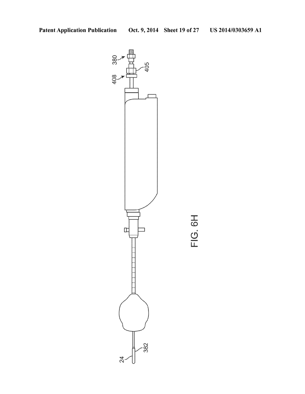 Water Enucleation of the Prostate - diagram, schematic, and image 20