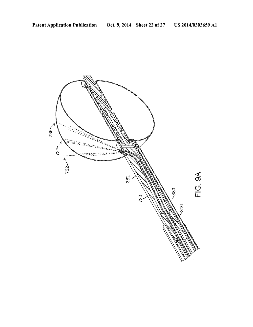 Water Enucleation of the Prostate - diagram, schematic, and image 23