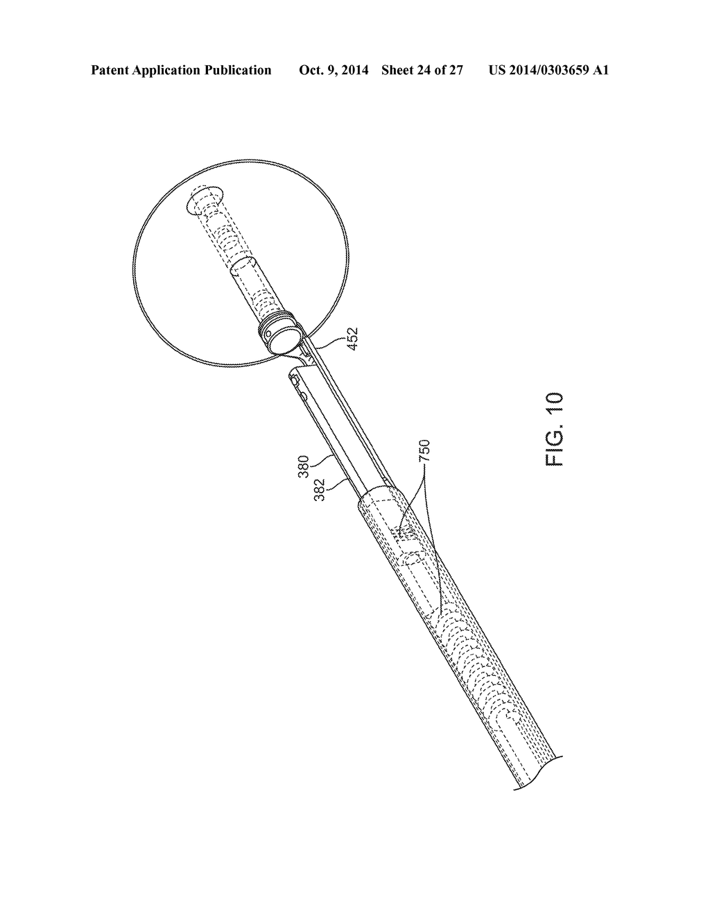 Water Enucleation of the Prostate - diagram, schematic, and image 25