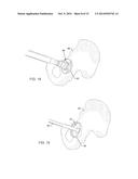 TOTAL HIP ARTHROPLASTY diagram and image