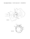 TOTAL HIP ARTHROPLASTY diagram and image