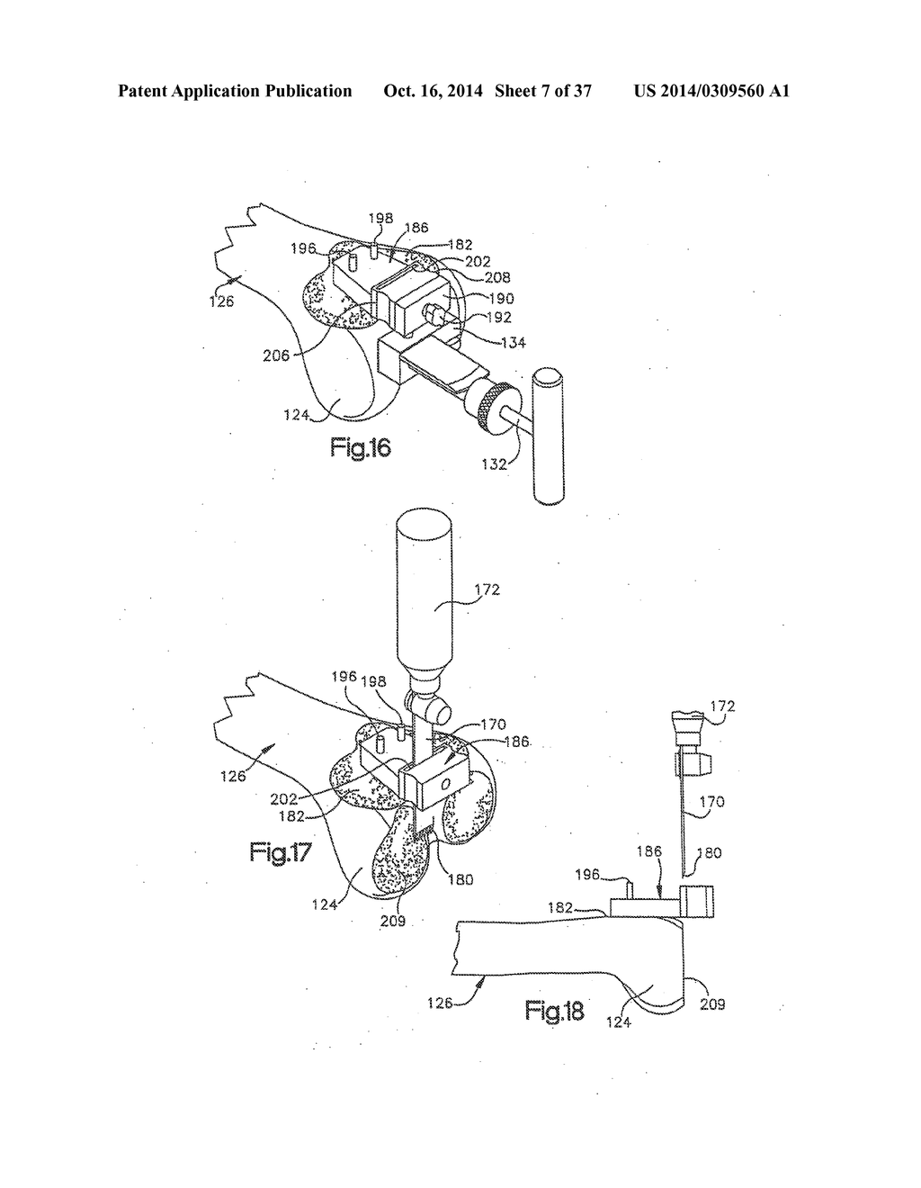 APPARATUS AND METHOD FOR MEASURING FORCES IN A KNEE JOINT - diagram, schematic, and image 08