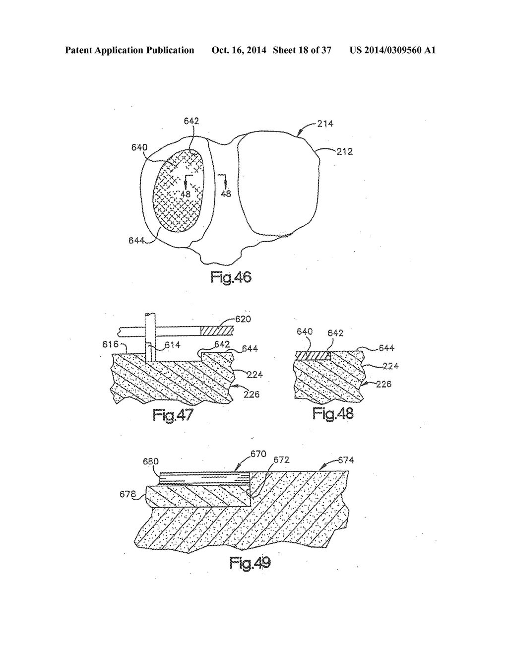 APPARATUS AND METHOD FOR MEASURING FORCES IN A KNEE JOINT - diagram, schematic, and image 19