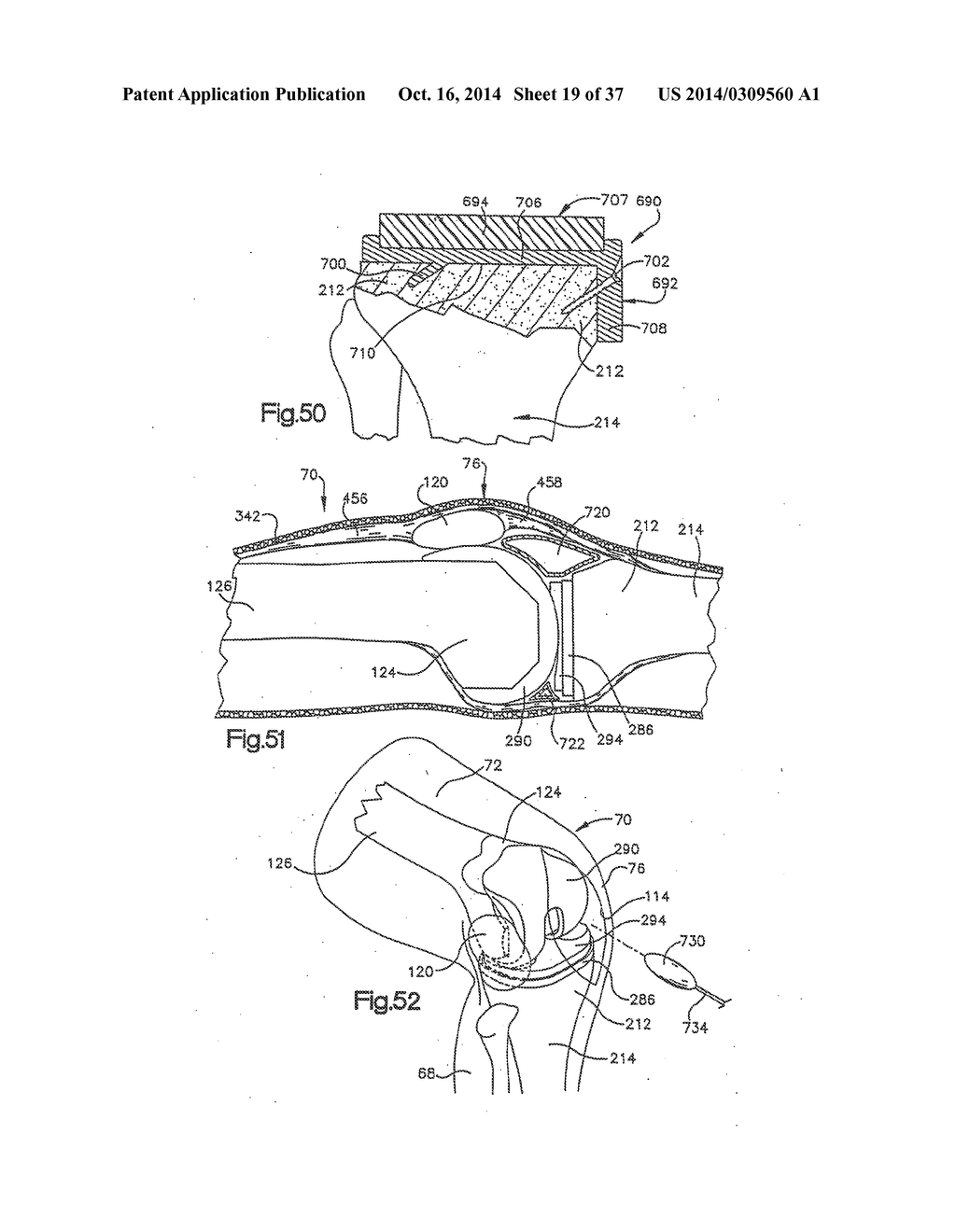 APPARATUS AND METHOD FOR MEASURING FORCES IN A KNEE JOINT - diagram, schematic, and image 20