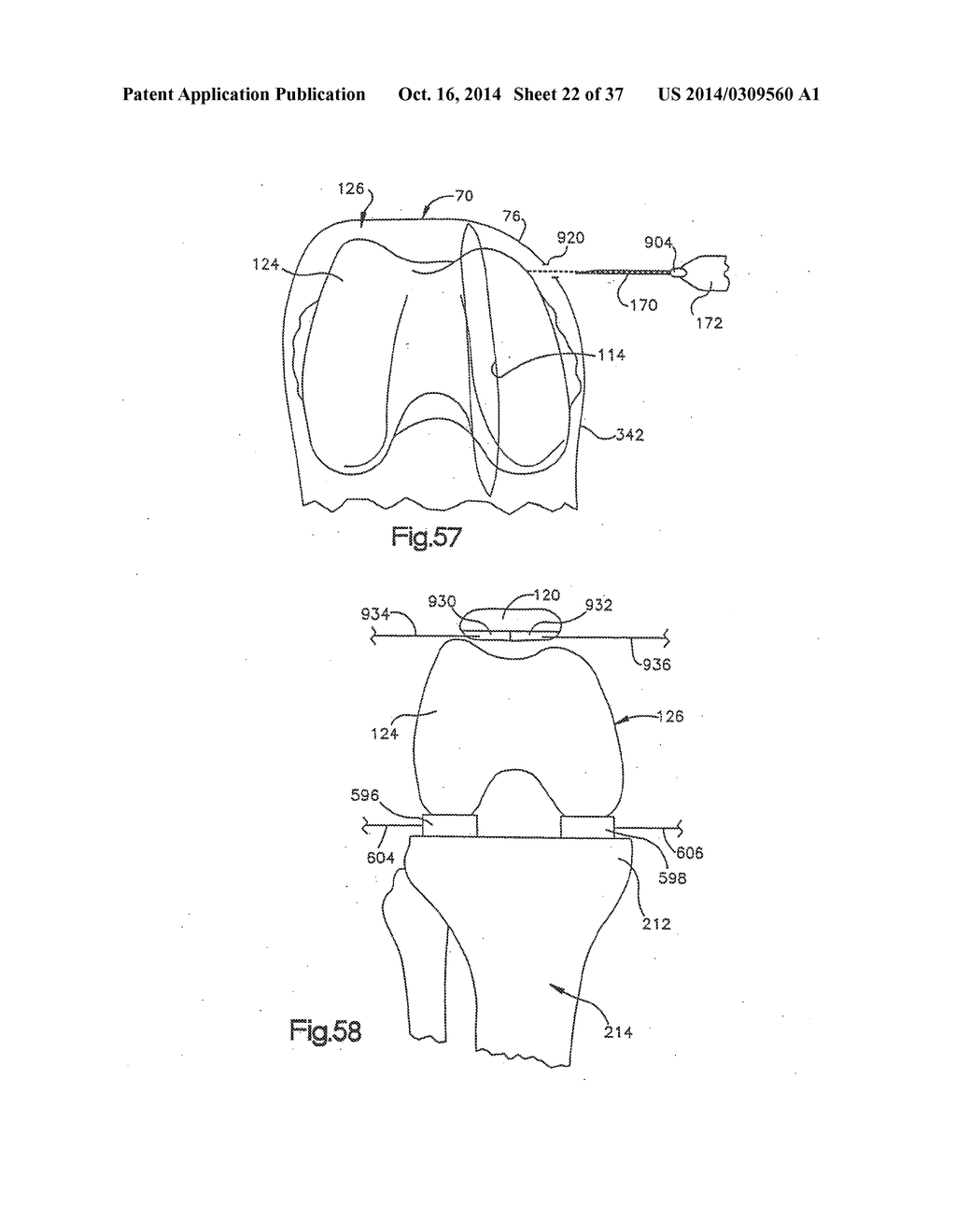 APPARATUS AND METHOD FOR MEASURING FORCES IN A KNEE JOINT - diagram, schematic, and image 23