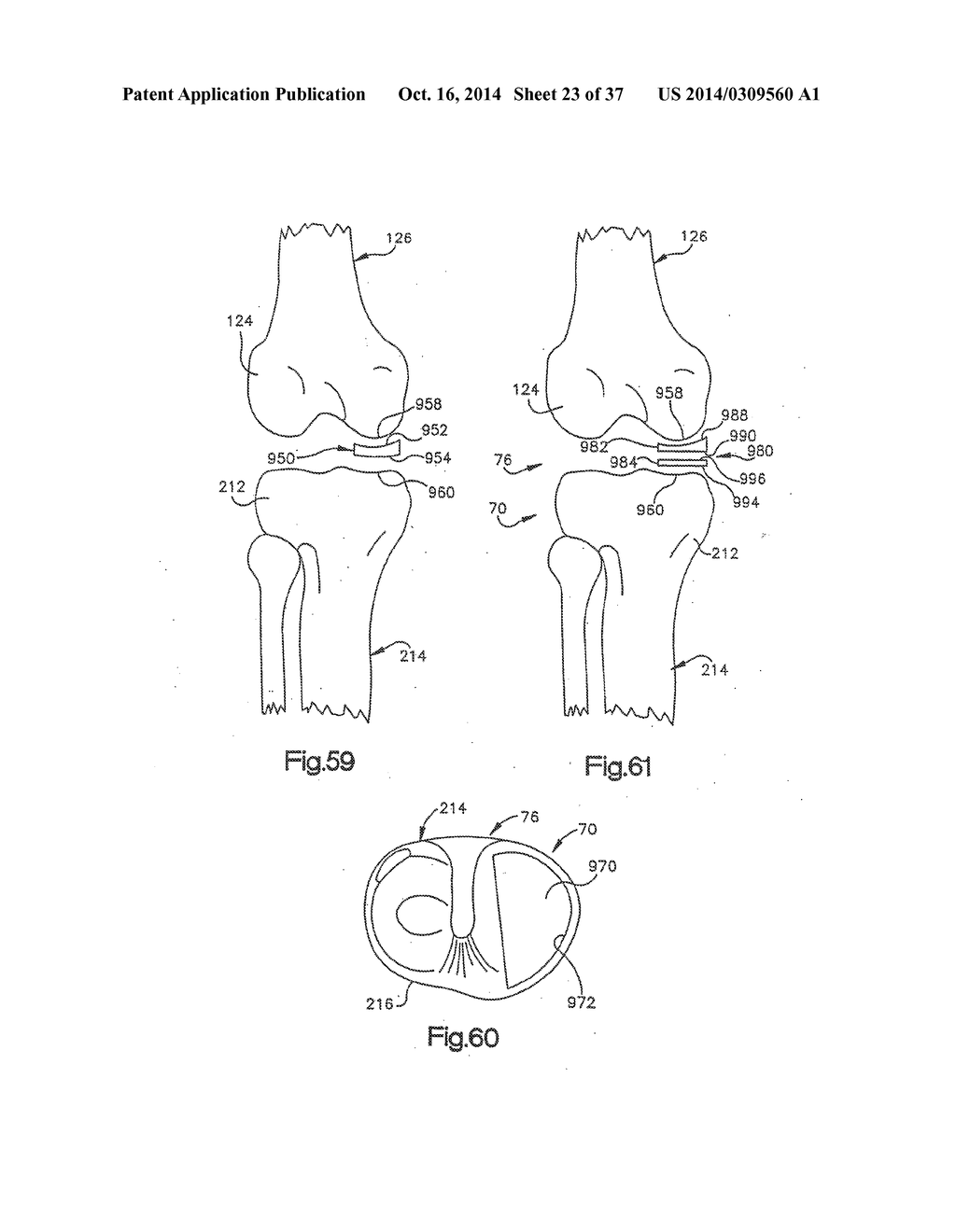 APPARATUS AND METHOD FOR MEASURING FORCES IN A KNEE JOINT - diagram, schematic, and image 24